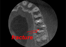 root fracture