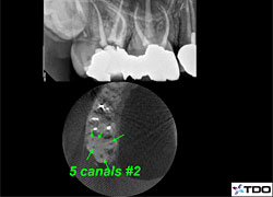 5 canal maxillary molar