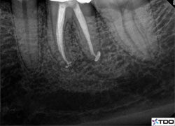 Post-op root canal