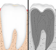 dental infection in tooth