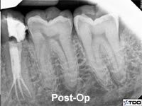 root canal post operative
