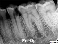 root canal pre operative