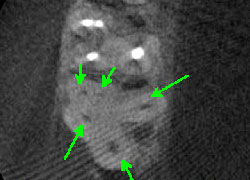 5 canal maxillary molar