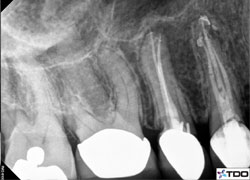 missed mesiobuccal canal