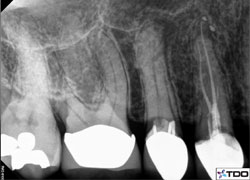 3 canal premolar