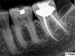 Post-op root canal