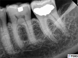 Pre-op root canal