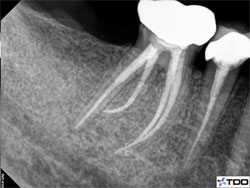 Post-op root canal