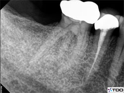 Pre-op root canal